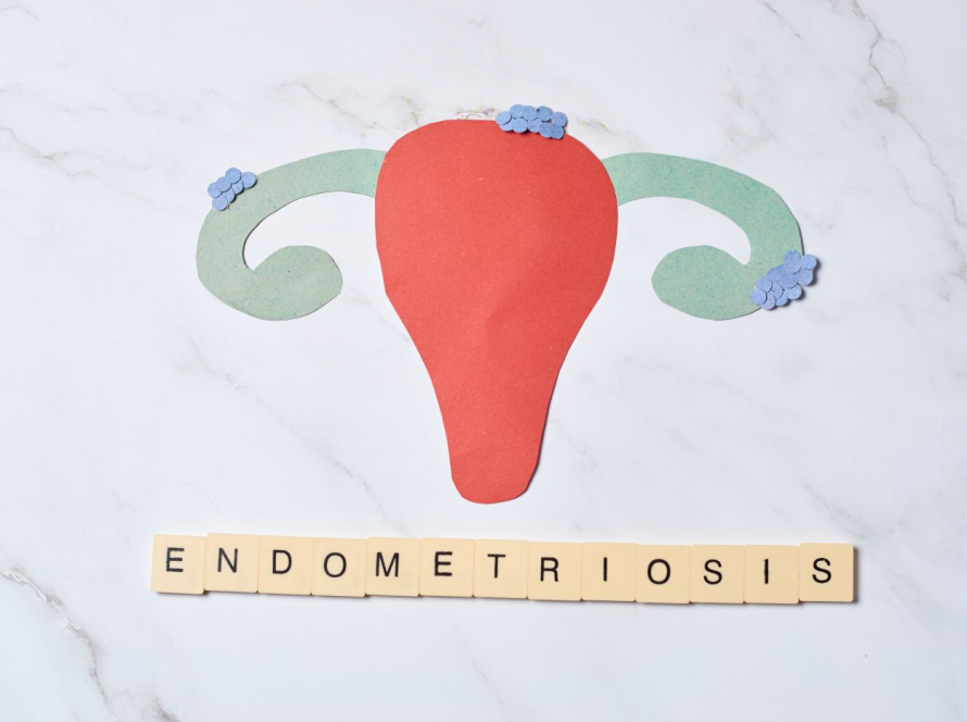 Endometrioza Dhe Shëndeti Mendor